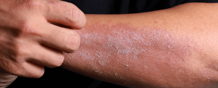 Can Seasonal Allergies Cause Eczema?