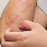 Food allergies like wheat allergy can cause eczema.