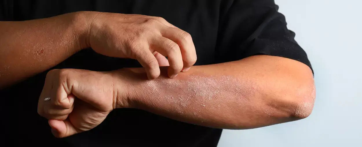 a person itching very dry skin